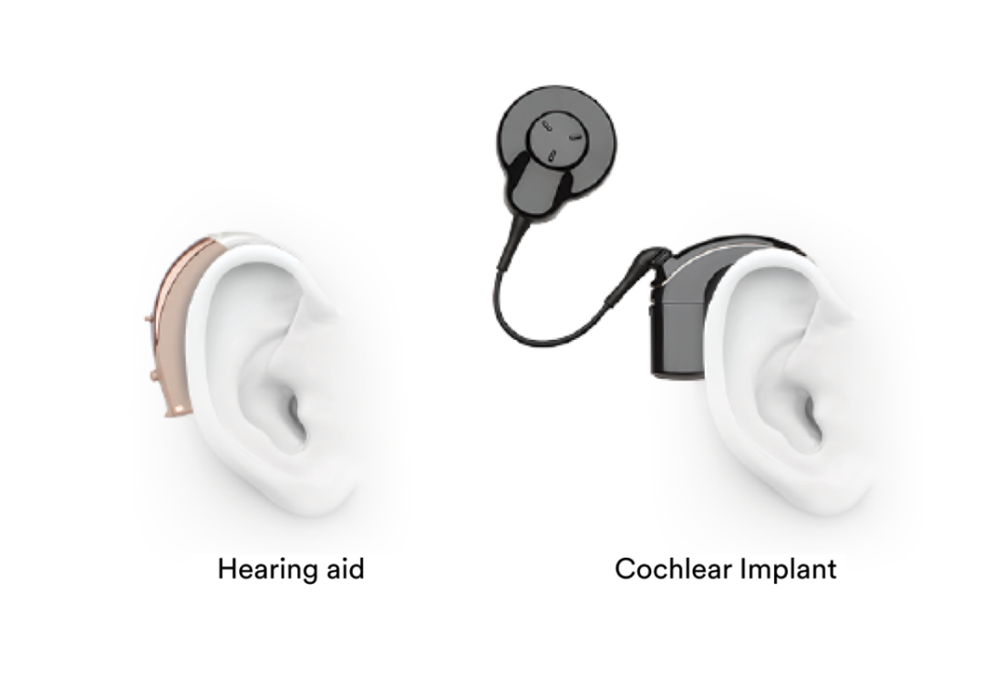 Cochlear Implant vs. Hearing Aid: Which is Better?