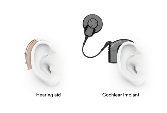 Cochlear Implant vs. Hearing Aid: Which is Better?