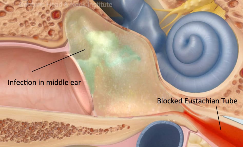 The Top Solution for Hearing Issues: Ear Tubes